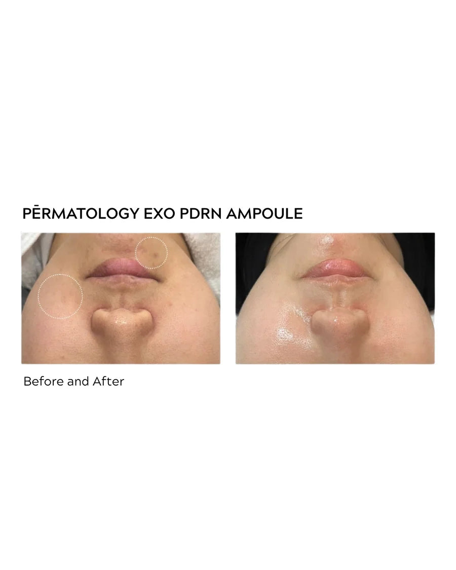 Permatology EXO-PDRN Recovery Ampoule